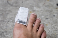 Mild and Severe Broken Toes