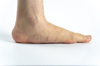 Causes, Symptoms, and Treatment of Flat Feet