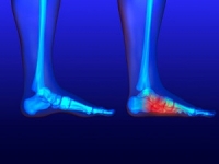 What Can I Do To Help My Flat Feet?