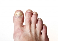 Symptoms and Possible Causes of Toenail Fungus