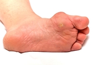 Causes of Corns on the Feet