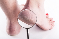 Cracked Heels Can Cause Difficulty in Walking