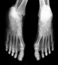 How Do Stress Fractures Develop?