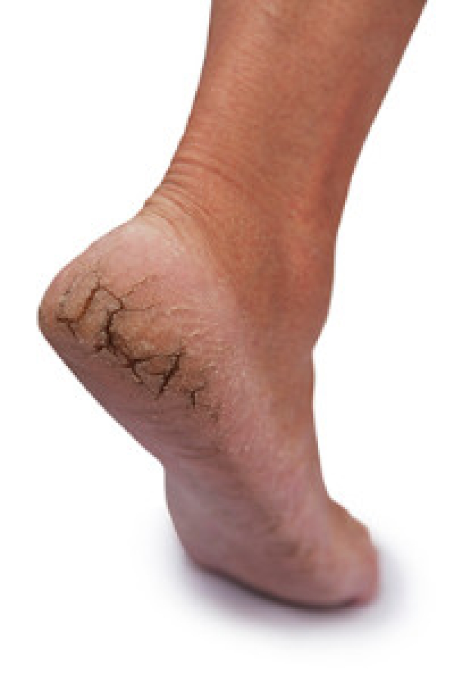 Cracked Heels – ZONE®DERMASURE® Skincare