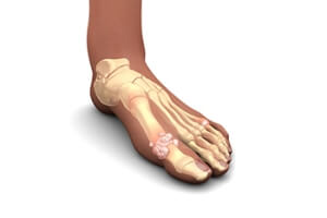 When Your Big Toe Joint Suddenly Becomes Painful
