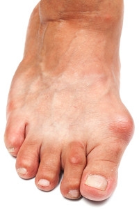 What are Bunions?